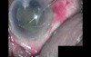 Cataract Surgery - Part 2/2