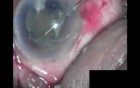 Cataract Surgery - Part 2/2