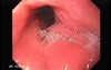 Scirrhous Gastric Carcinoma - Endoscopy (11 of 47)