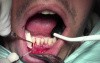 Threading Technique - Gingival Grafting #26-25-24