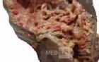 Jejunal Gastrointestinal Stromal tumor (GIST) (9 of 86)
