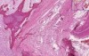 Vertebrae- Fracture Callus