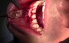 Guided Tissue Regeneration and FGG Surgery, #25