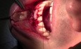 Guided Tissue Regeneration and FGG Surgery, #25