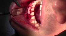 Guided Tissue Regeneration and FGG Surgery, #25