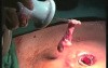 SILS Abdominal Access