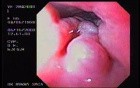 Banding of Esophageal Varices - 65 Years-Old Female