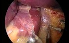 Laparoscopic Adjustable Gastric Band Surgery