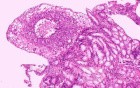 Ovarian Carcinoma Metastatic to Stomach and Duodenum (16 of 20)