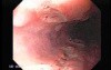 Pill Esophagitis - 5/5