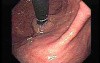 Retroflexed Image of Narrowed Gastroesophageal Junction