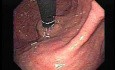 Retroflexed Image of Narrowed Gastroesophageal Junction
