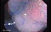 Sessile Tubulovillous Adenoma (6 of 11)