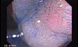 Sessile Tubulovillous Adenoma (6 of 11)