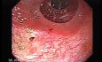 Ileal Neobladder Substitution (ileal bladder) (6 of 9)