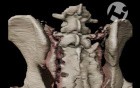 Volumated Pelvis