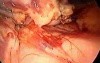 Laparoscopic distal pancreatectomy with splenectomy