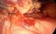 Laparoscopic distal pancreatectomy with splenectomy
