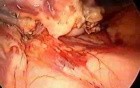 Laparoscopic distal pancreatectomy with splenectomy