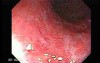 Ulcerative Colitis - Endoscopy (1 of 5)