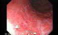 Ulcerative Colitis - Endoscopy (1 of 5)