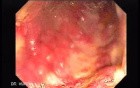 Multiple Rectal Ulcers (14 of 110)