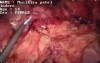 Laparoscopic Appendectomy - 19 year old girl