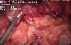 Laparoscopic Appendectomy - 19 year old girl