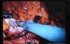 Jejunal Gastrointestinal Stromal tumor (GIST) (42 of 86)