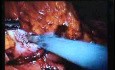 Jejunal Gastrointestinal Stromal tumor (GIST) (42 of 86)
