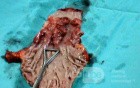 Barrett Adenocarcinoma - Endoscopic Image (19 of 20)