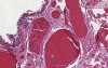 Hemorrhoids