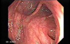 Non Familial Juvenile Polyposis Of The Colon (18 of 37)