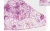 Bronchopneumonia