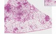 Bronchopneumonia