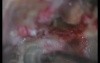 Petroclival Meningioma - Right Transpetrosal Approach
