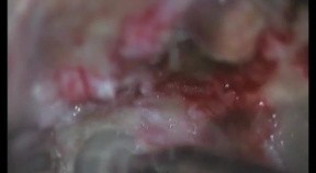 Petroclival Meningioma - Right Transpetrosal Approach