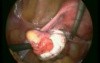 Laparoscopic Surgery Of Fallopian Tube