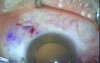 Pterygium Excision And Conjunctival  Autograft