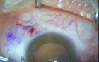 Pterygium Excision And Conjunctival  Autograft