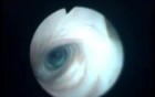 Pulsations of The Tracheal Wall