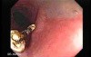 Colonoscopic Polypectomy (16 of 29)