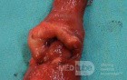 Barrett Adenocarcinoma - Endoscopic Image (17 of 20)