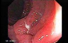 Inespecific Diverticulitis (4 of 4)