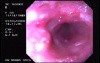 Severe Case Of Ulcerative Colitis (2 of 6)
