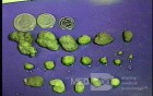 Juvenile Non Familial Polyposis of the Colon (13 of 37)