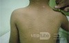 Herald Patch - Pityriasis Rosea