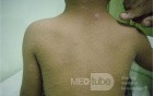 Herald Patch - Pityriasis Rosea