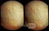 Lymphatics of the Conjunctiva - 3D