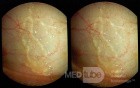 Lymphatics of the Conjunctiva - 3D